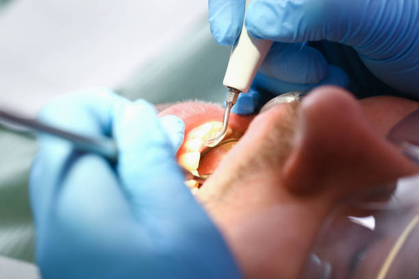 Best Knocked-Out Tooth (Avulsed Tooth) Treatment in Joplin, MO